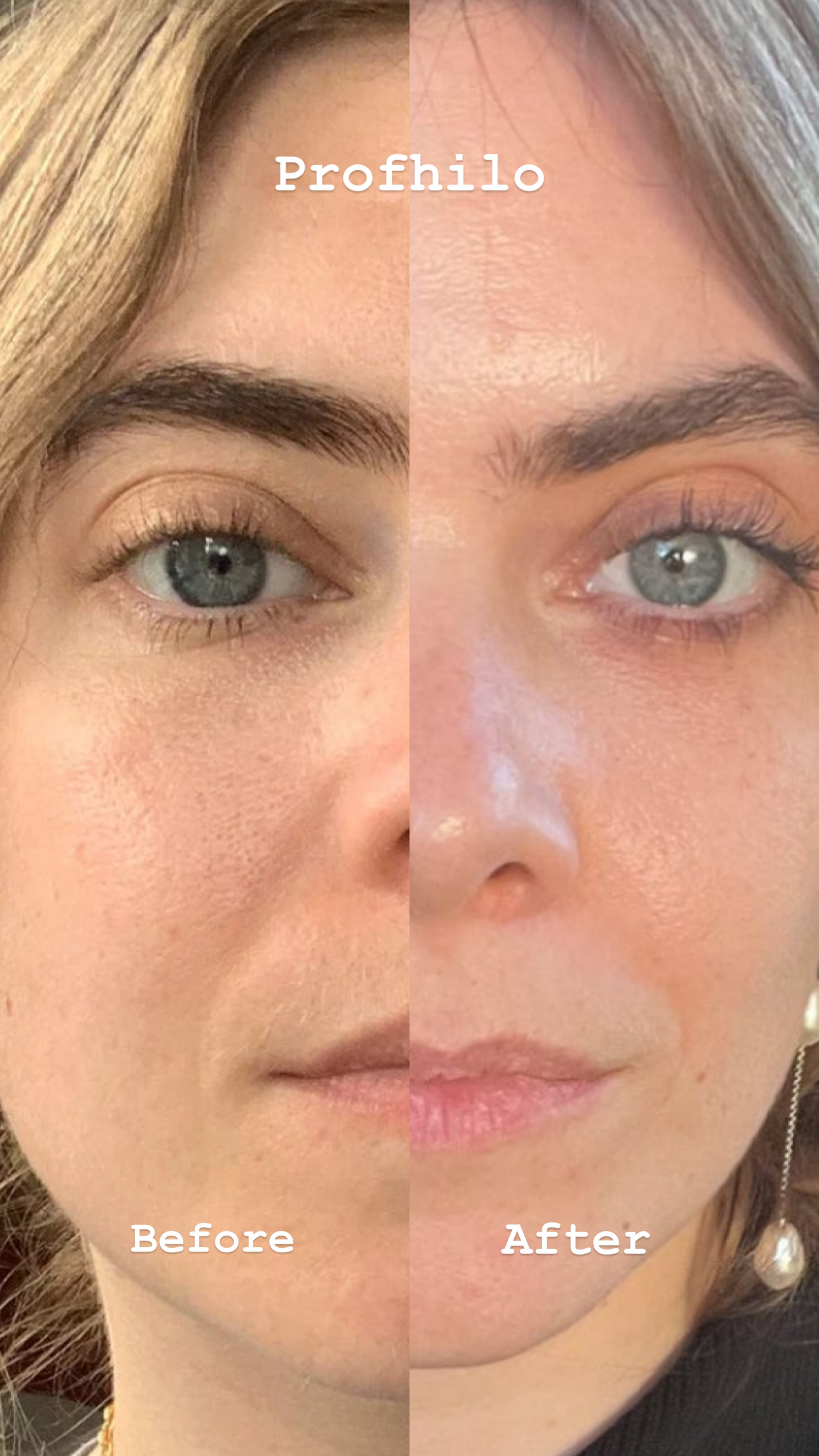Profhilo before and after - face rejuvenation