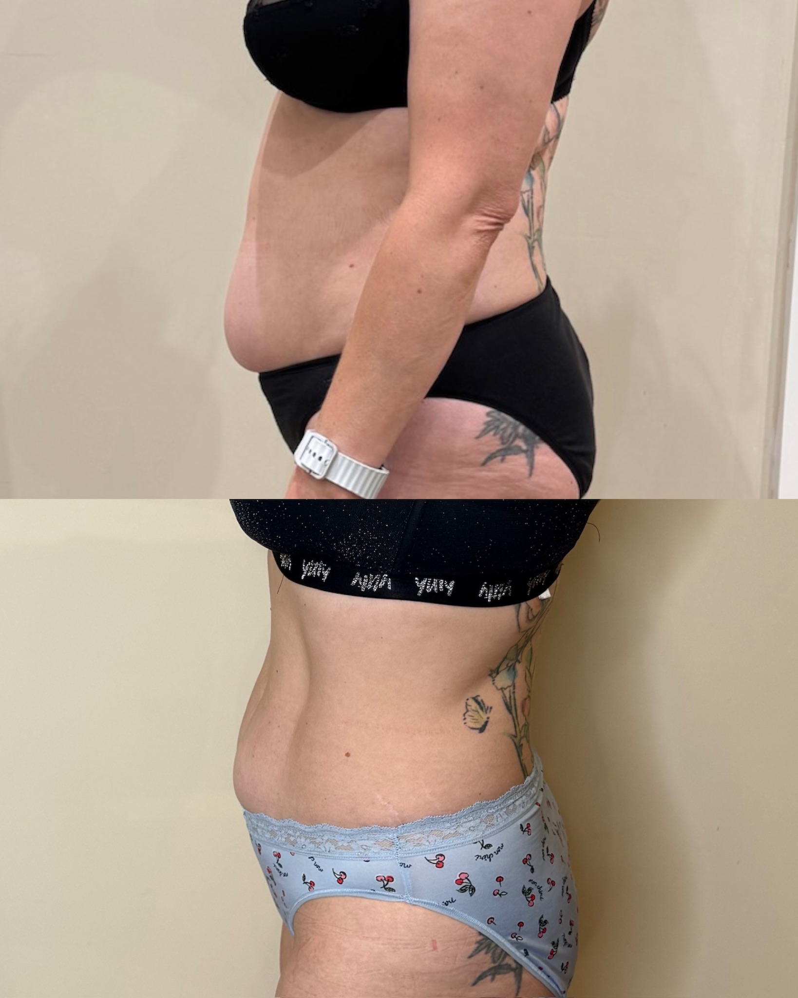 Emsculpt NEO before and after side view