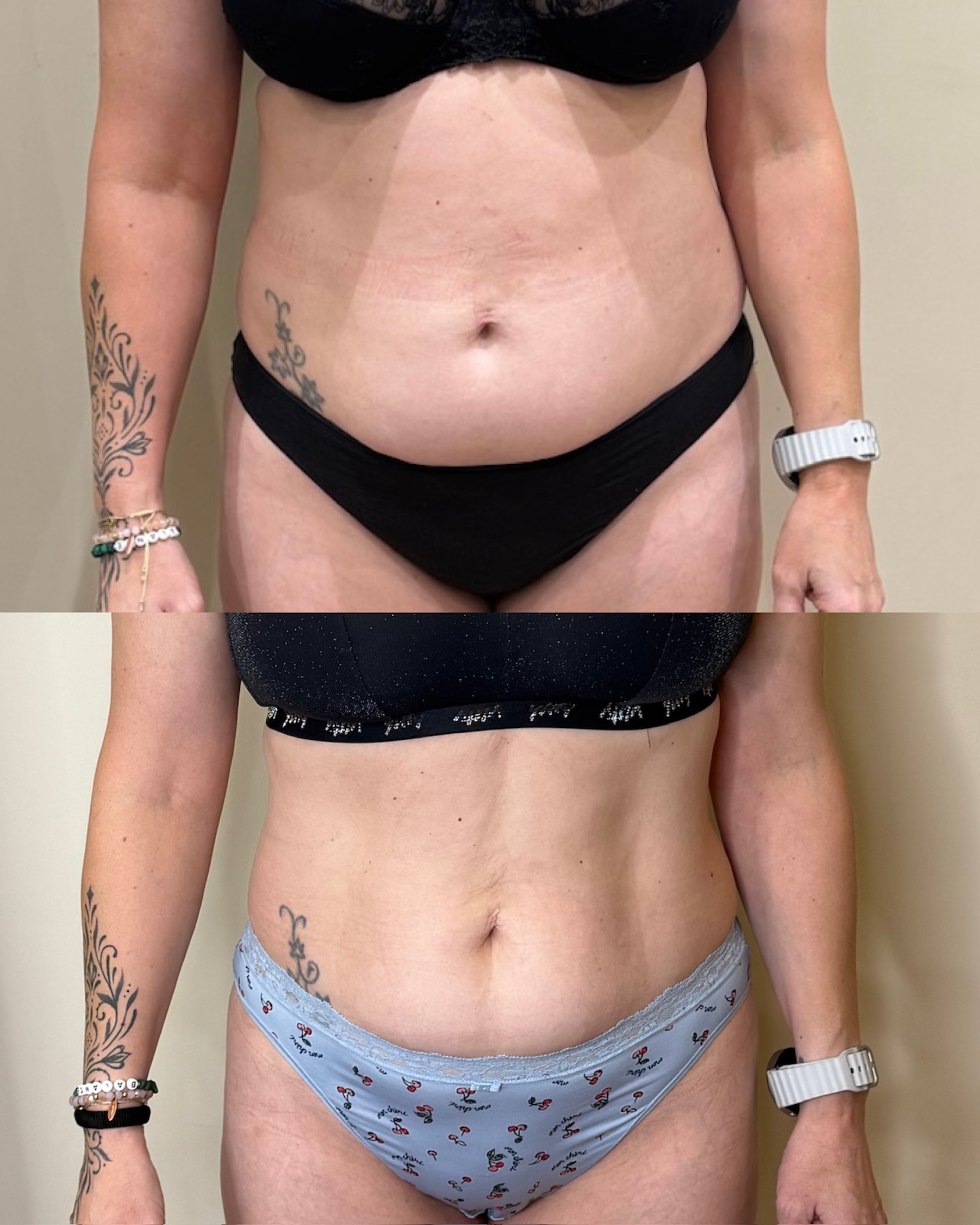 Emsculpt NEO before and after front view