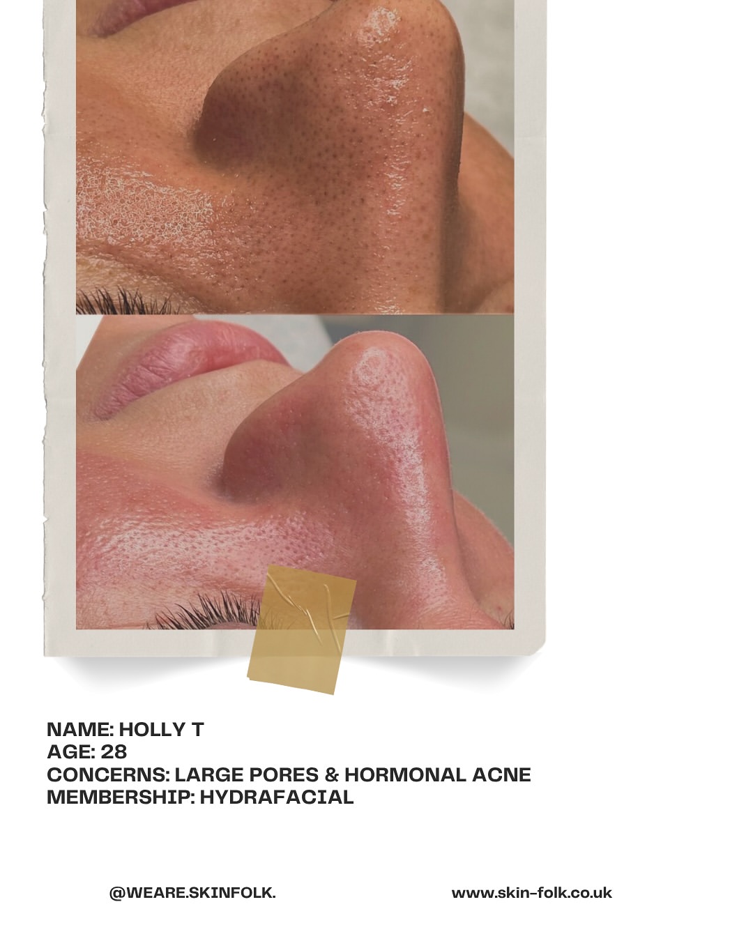 Holly T - HydraFacial membership results