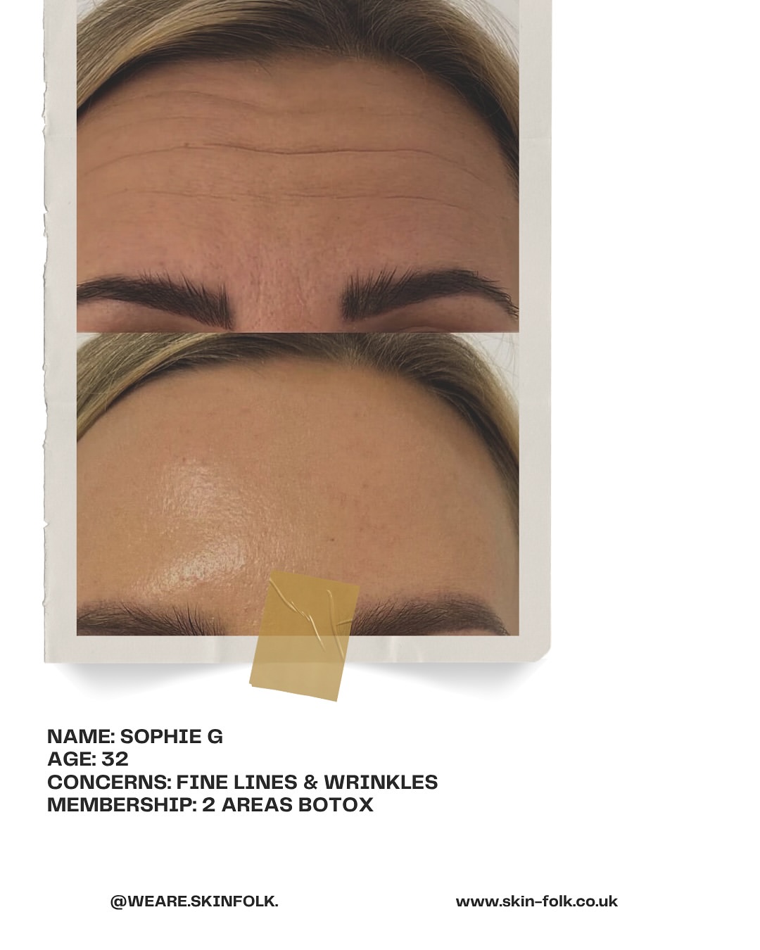 Sophie G - 2 Areas Botox membership results