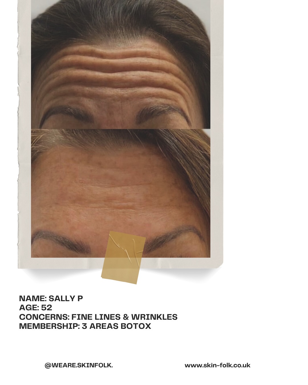 Sally P - 3 Areas Botox membership results