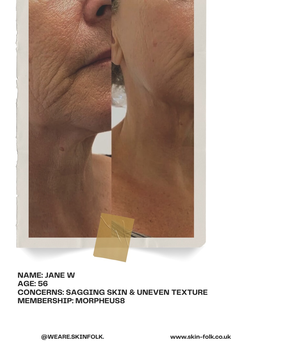 Jane W - Morpheus8 membership results