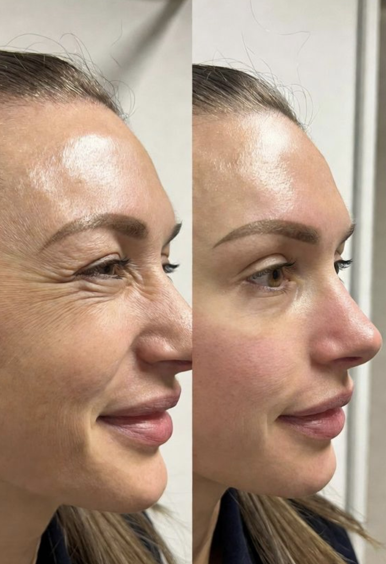 Before and after - crow's feet treatment