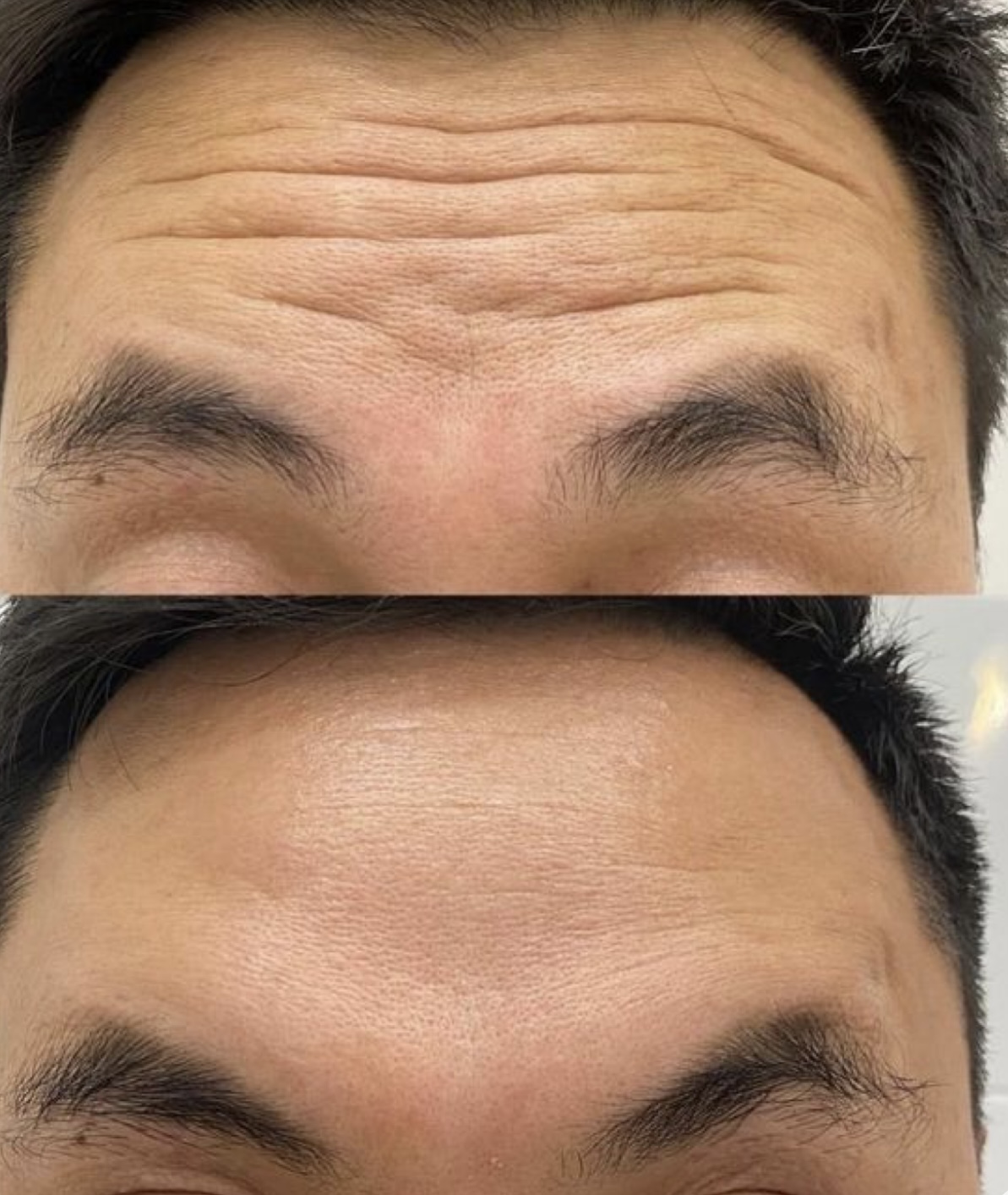 Before and after - forehead lines treatment