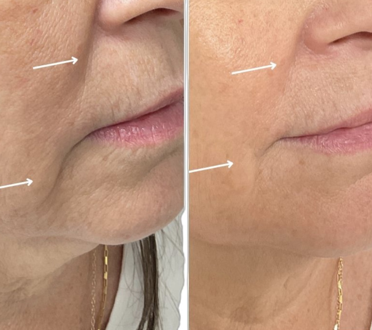 Before and after - nasolabial fold treatment