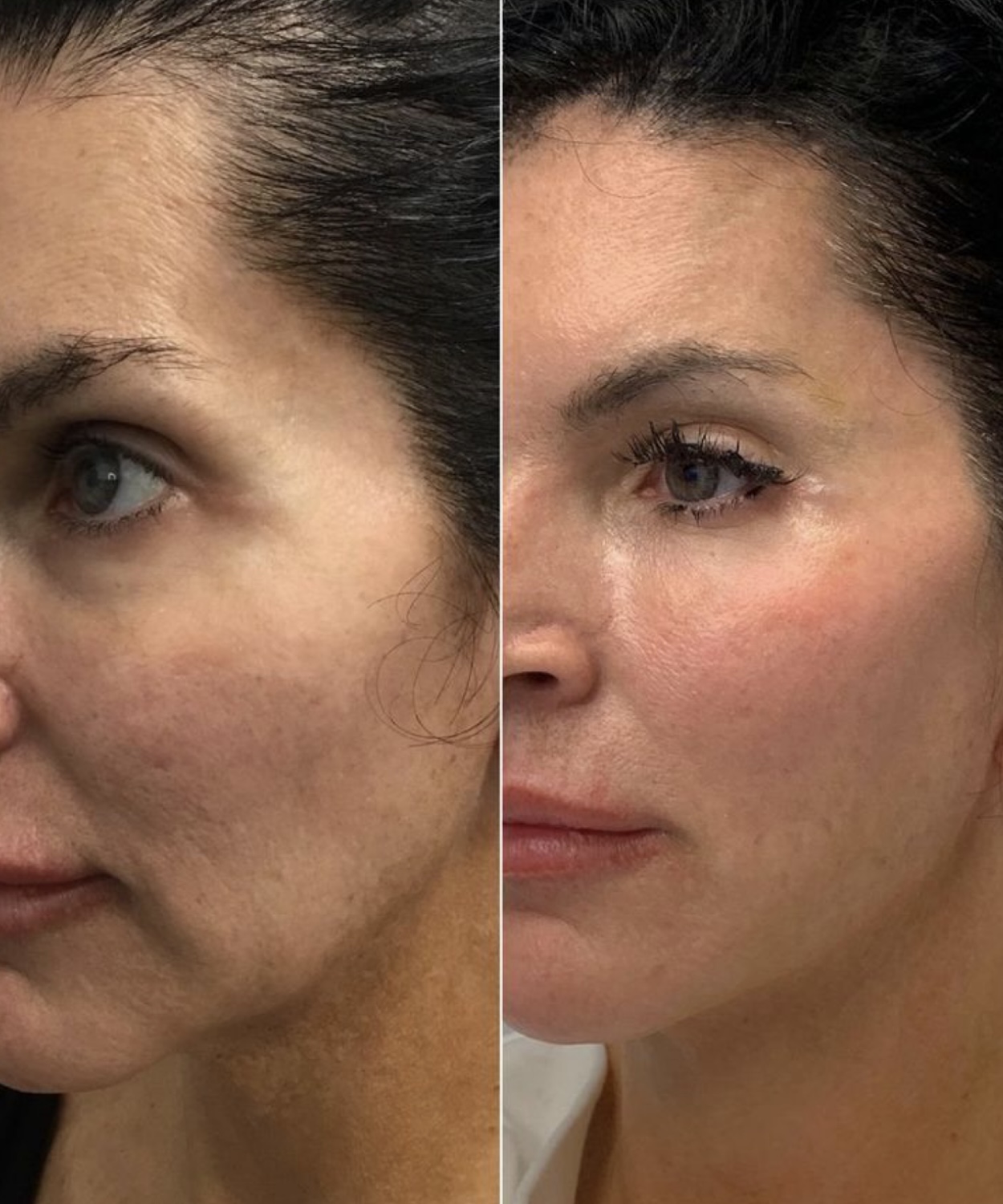 Before and after - full face rejuvenation