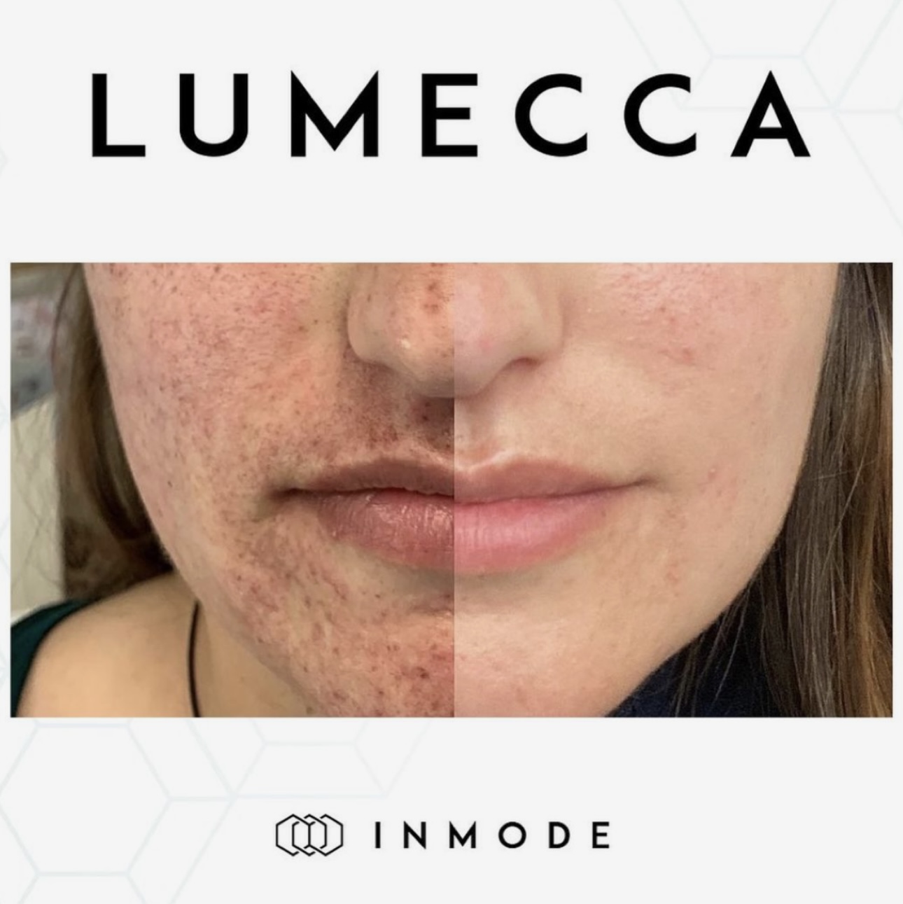 Lumecca IPL before and after results