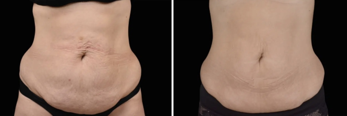 Emsculpt Classic before and after results