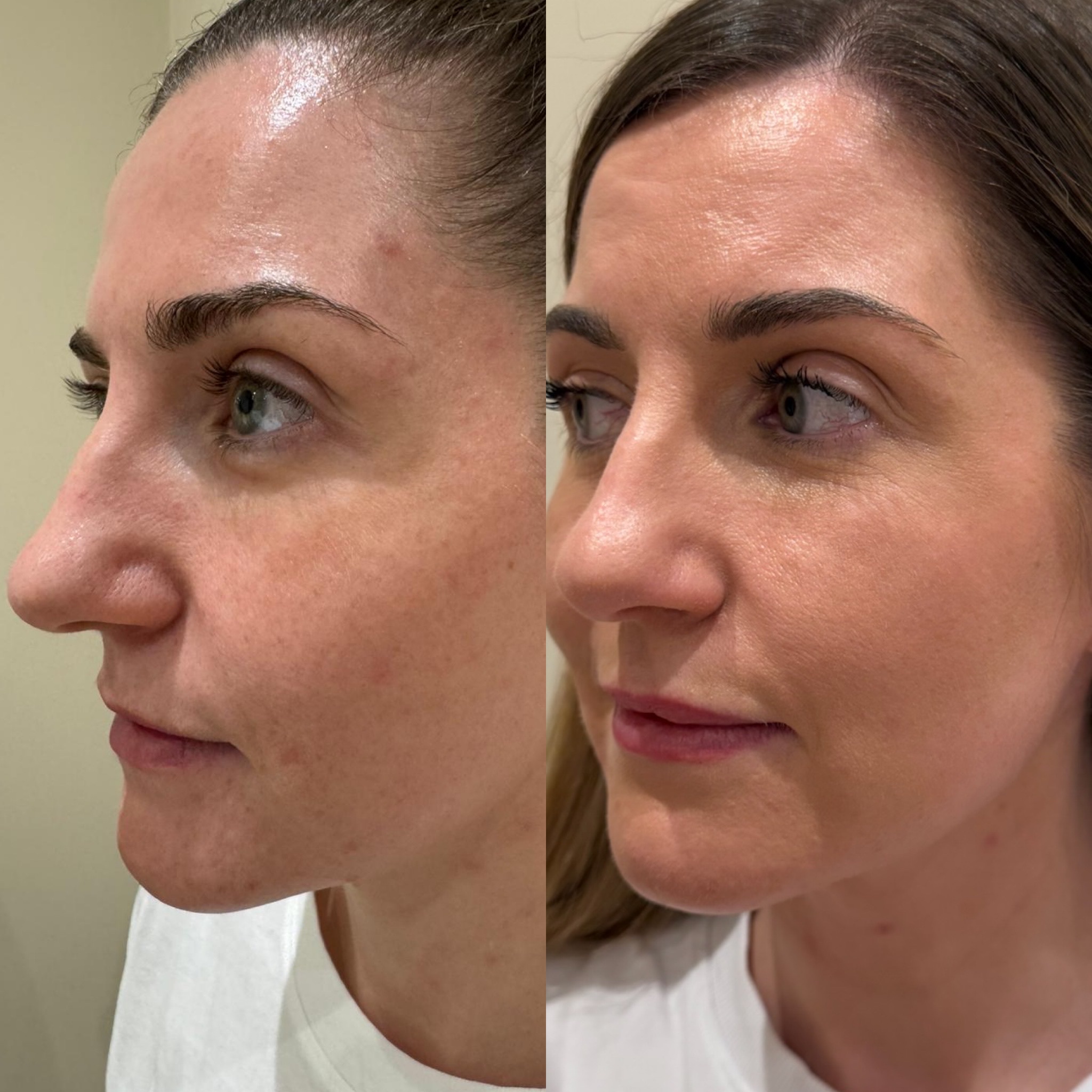Before and after - facial contouring