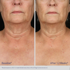 Obagi Neck and Décolleté