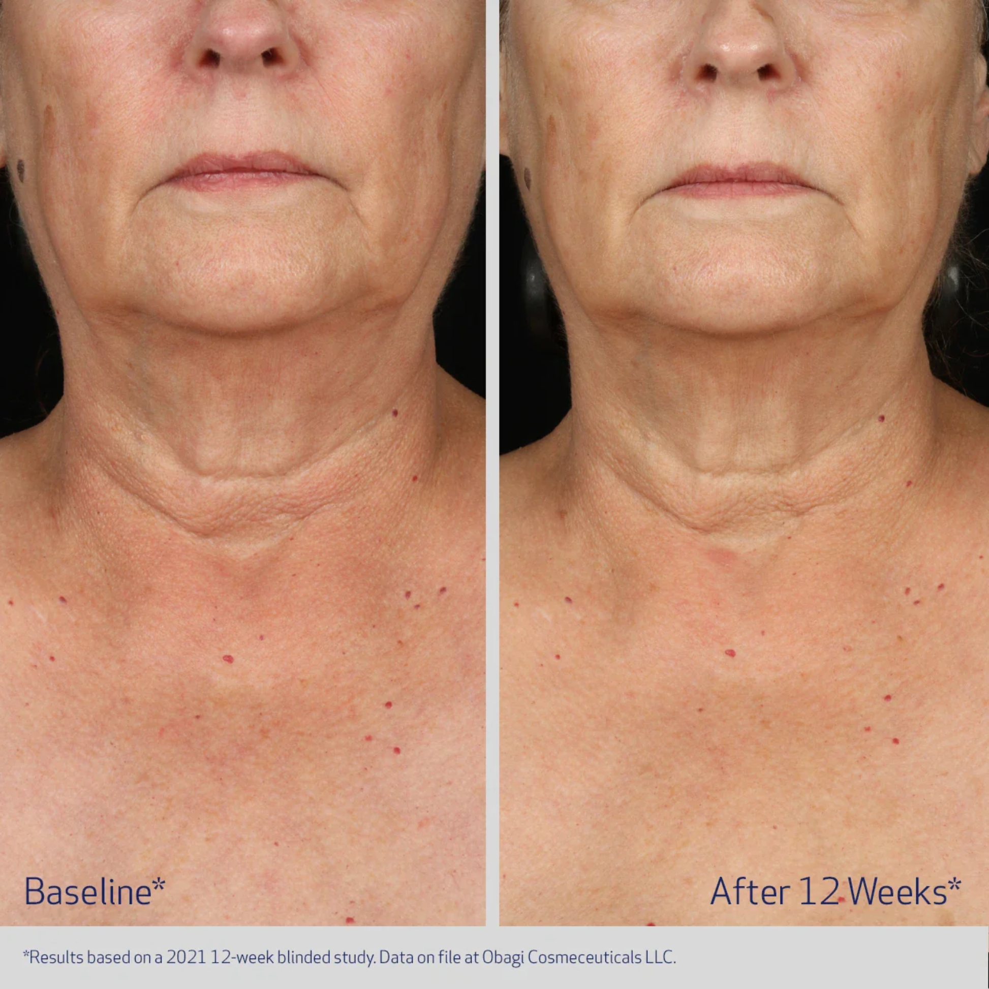 Obagi Neck and Décolleté