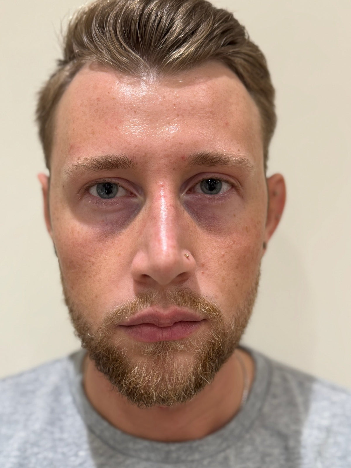 Frown lines softened after anti-wrinkle injections at Skinfolk in Droitwich