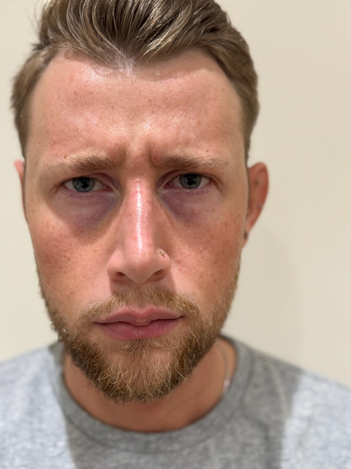 Frown lines before anti-wrinkle injections at Skinfolk in Droitwich