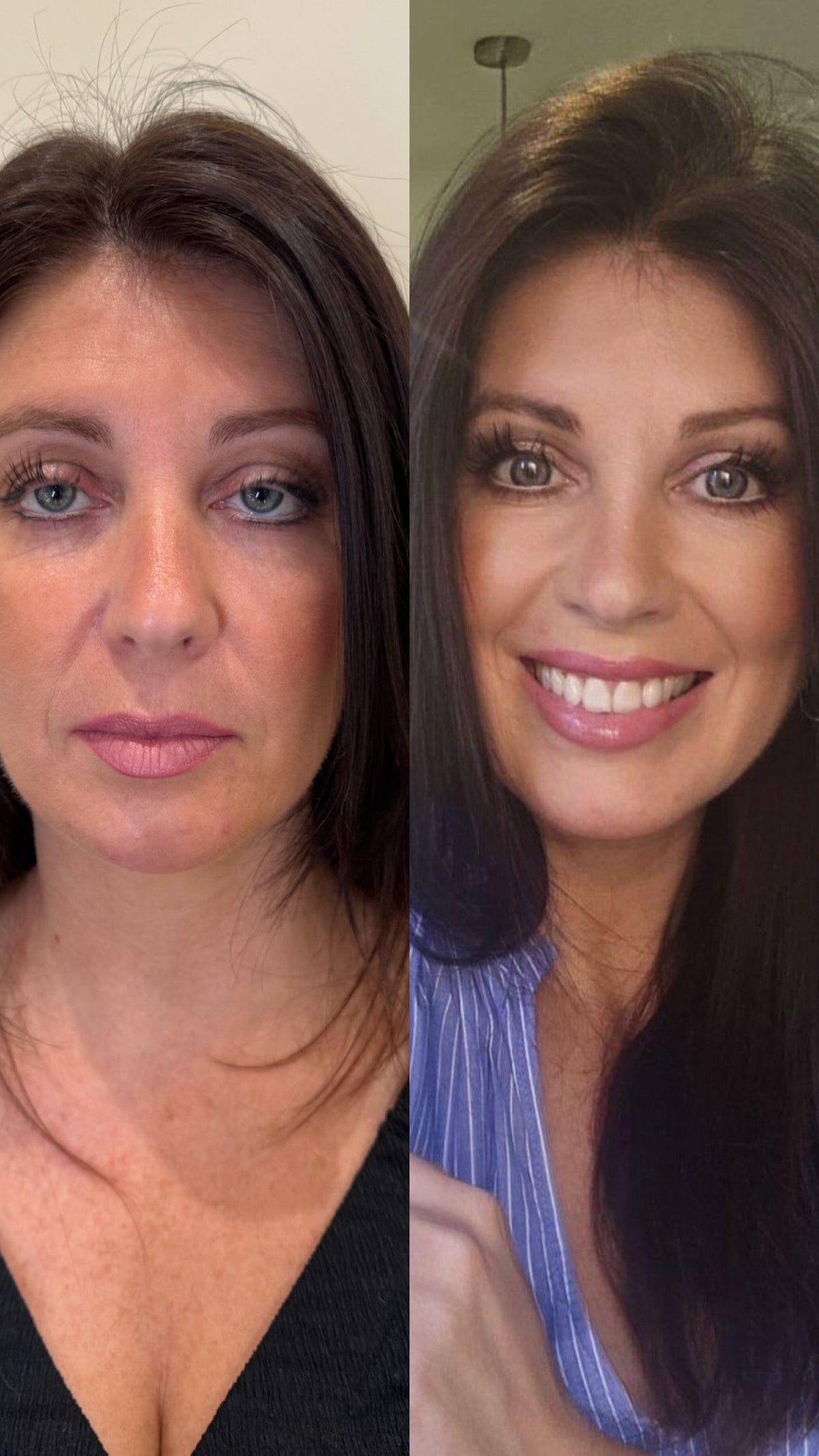 Before and after at Skinfolk in Droitwich: cheek filler to lift, a Skin SOS advanced facial, anti-wrinkle injections to lift the brows and polynucleotides under the eyes