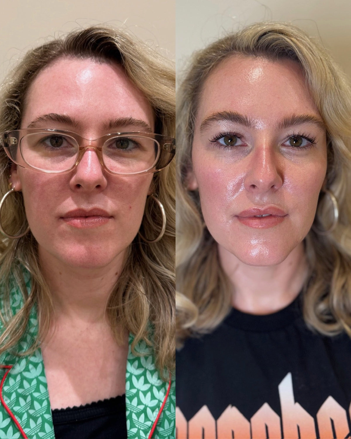 Before and after the Skinfolk Entry Glow programme in Droitwich: anti-wrinkle injections, HydraFacial and two Profhilo treatments over four visits